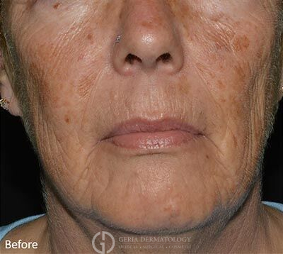 Before Image: Patient Case #6901 - front