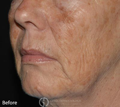 Before Image: Patient Case #6901 - left-front-oblique