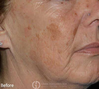 Before Image: Patient Case #6901 - right-front-oblique