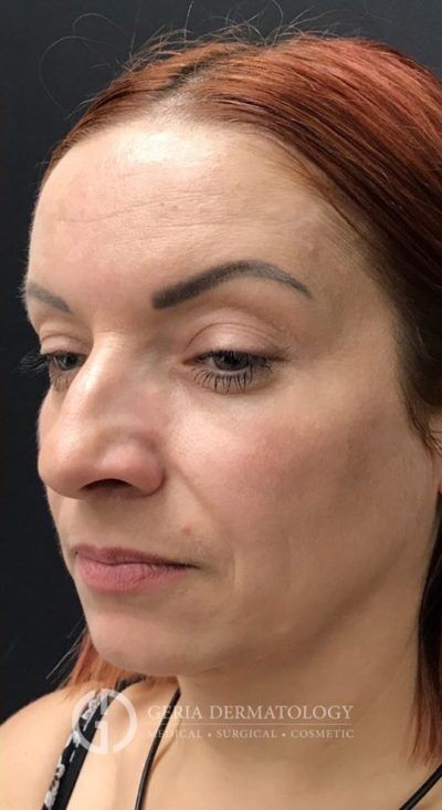 After Image: Patient Case #8960 - left-front-oblique