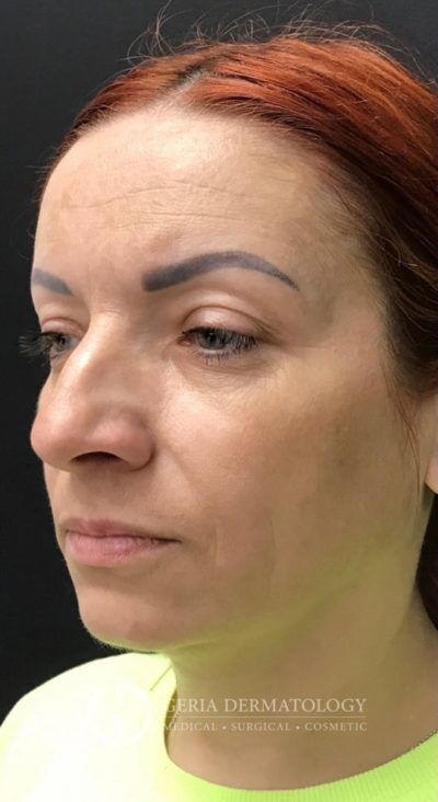 Before Image: Patient Case #8960 - left-front-oblique