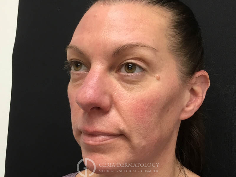 After Image: Patient Case #48065 - left-front-oblique