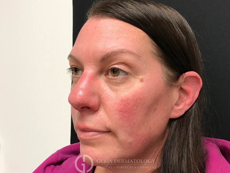 Before Image: Patient Case #48065 - left-front-oblique