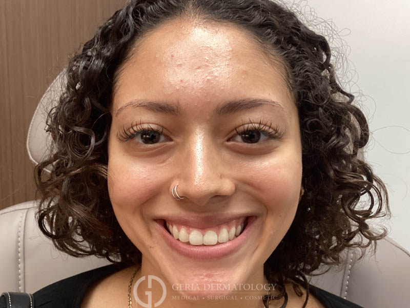 Before Image: Patient Case #48068 - front