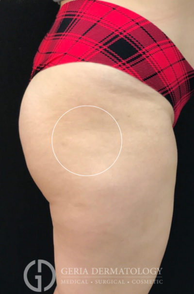 Before Image: Patient Case #11580 - right-side