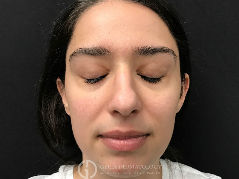 Before Image: Patient Case #48077 - front