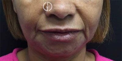 Before Image: Patient Case #3937 - front