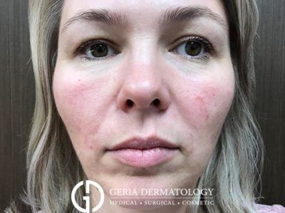 After Image: Patient Case #5112 - front