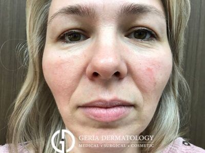 Before Image: Patient Case #5112 - front