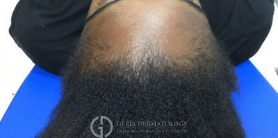 Before Image: Patient Case #2856 - back