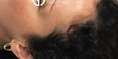 After Image: Patient Case #2858 - left-side