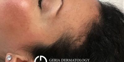 Before Image: Patient Case #2858 - left-side