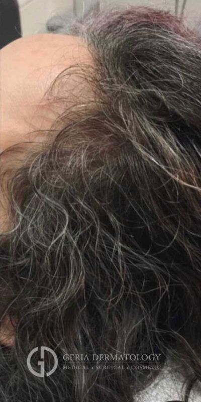 After Image: Patient Case #2860 - left-back-oblique