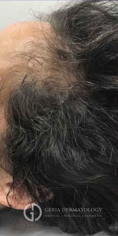 Before Image: Patient Case #2860 - left-back-oblique