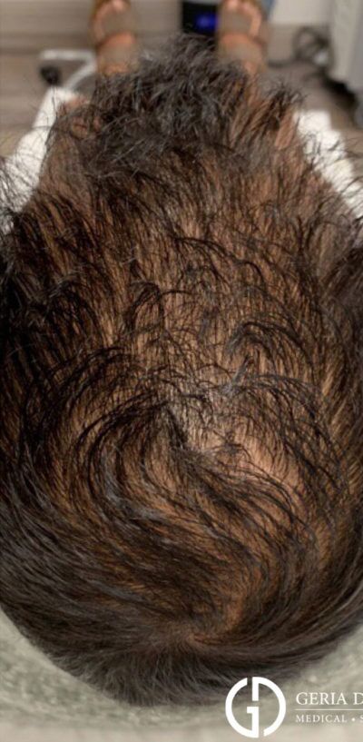 Before Image: Patient Case #2861 - back