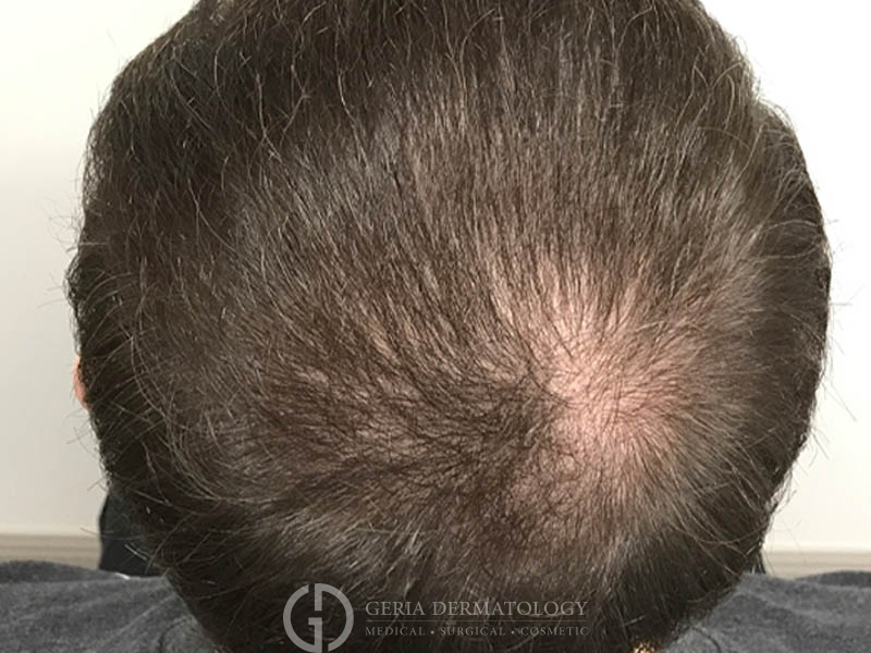 Before Image: Patient Case #48086 - back