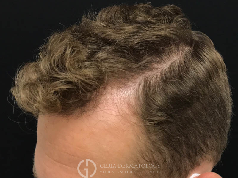 After Image: Patient Case #48089 - left-front-oblique