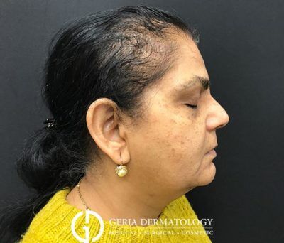 Before Image: Patient Case #5120 - right-side