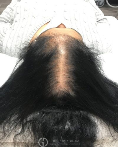 Before Image: Patient Case #5588 - back