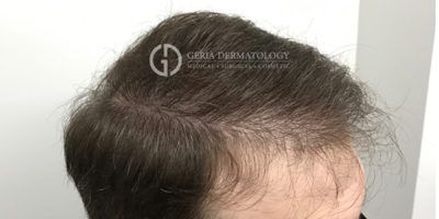 Before Image: Patient Case #7075 - right-front-oblique