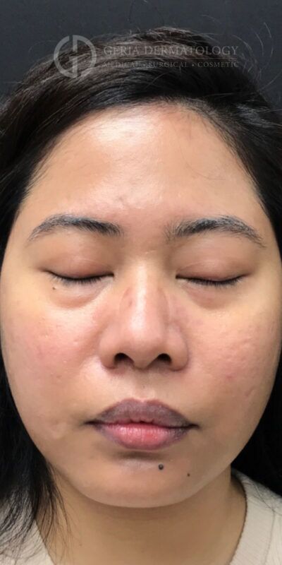 After Image: Patient Case #15429 - front