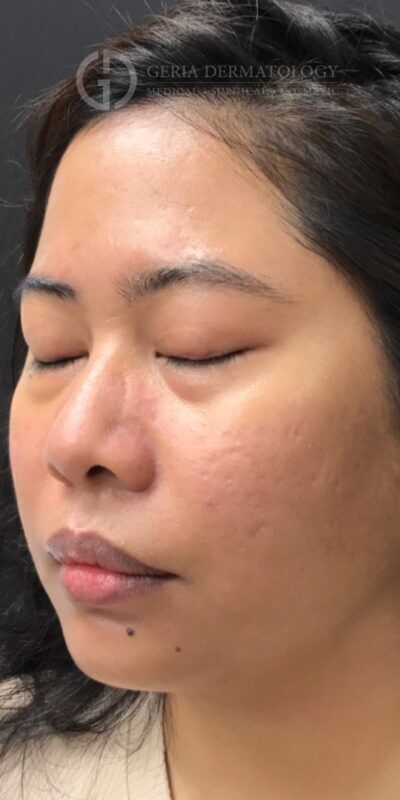 After Image: Patient Case #15429 - left-front-oblique