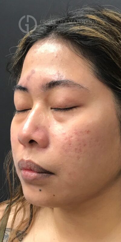 Before Image: Patient Case #15429 - left-front-oblique