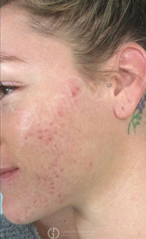 Before Image: Patient Case #8351 - left-front-oblique