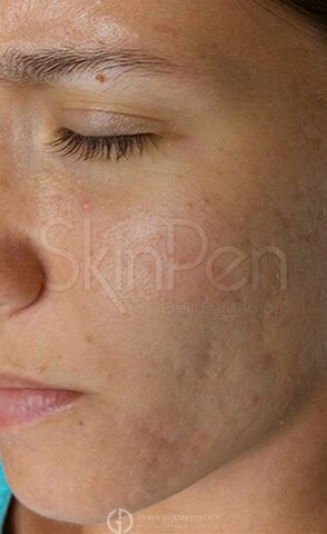 After Image: Patient Case #8352 - left-front-oblique