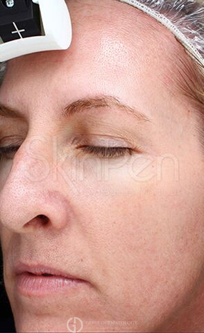 After Image: Patient Case #8354 - left-front-oblique