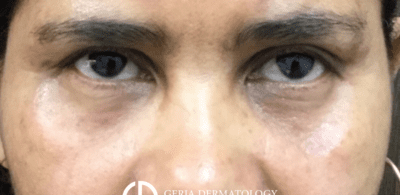 Before Image: Patient Case #2996 - front