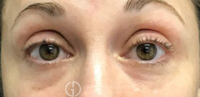 Before Image: Patient Case #5583 - front