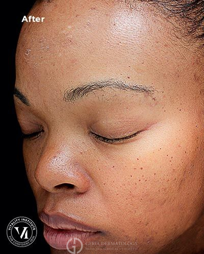 After Image: Patient Case #5981 - left-front-oblique