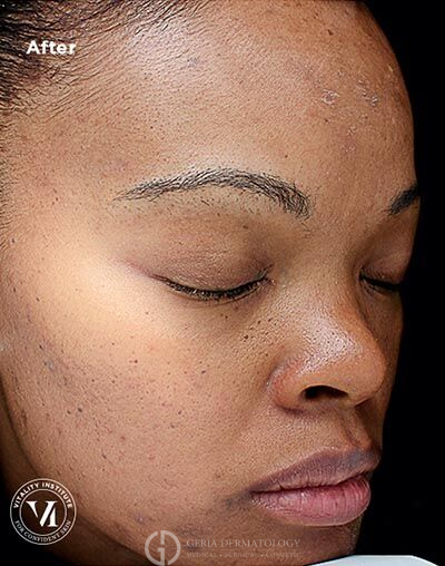 After Image: Patient Case #5981 - right-front-oblique