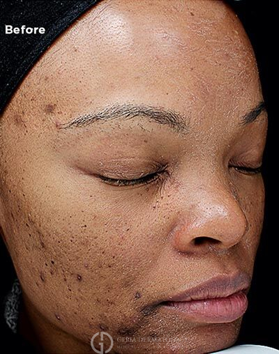 Before Image: Patient Case #5981 - right-front-oblique