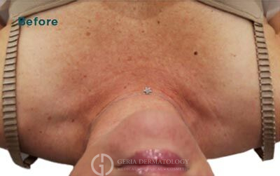 Before Image: Patient Case #5992 - front