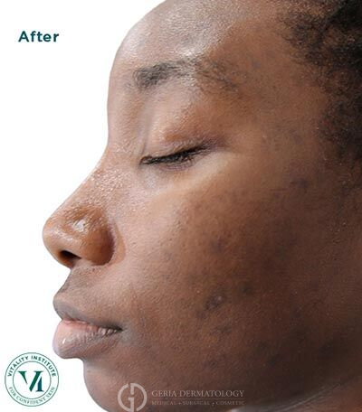 After Image: Patient Case #5995 - left-side