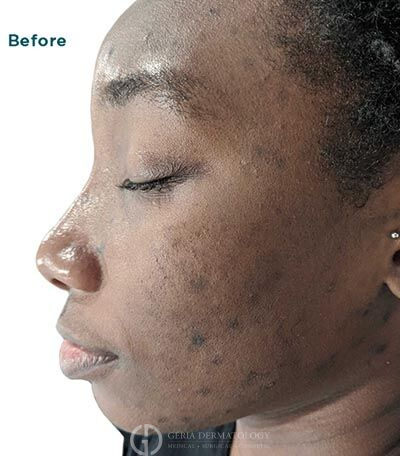 Before Image: Patient Case #5995 - left-side