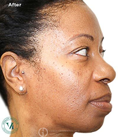 After Image: Patient Case #6000 - right-side