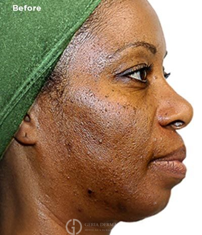 Before Image: Patient Case #6000 - right-side