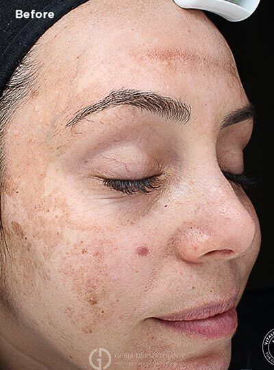 Before Image: Patient Case #6003 - right-front-oblique