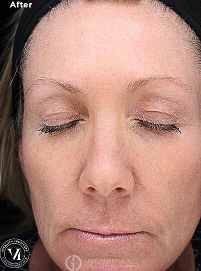 After Image: Patient Case #6006 - front