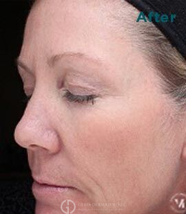 After Image: Patient Case #6006 - left-front-oblique