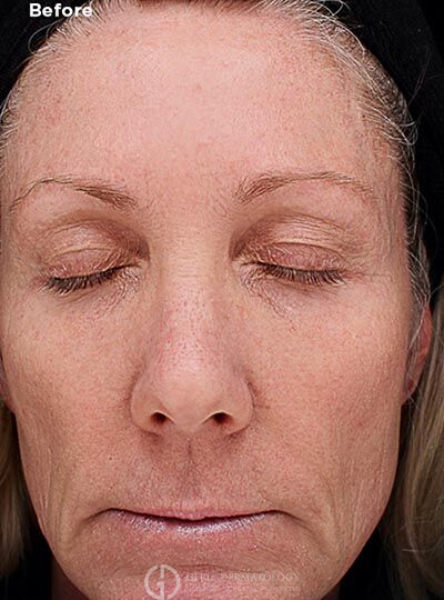 Before Image: Patient Case #6006 - front