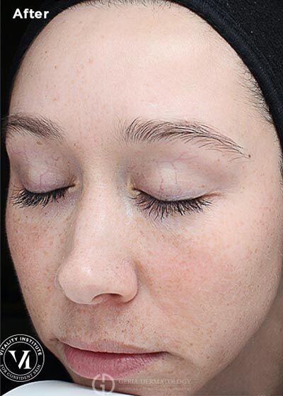 After Image: Patient Case #6011 - left-front-oblique