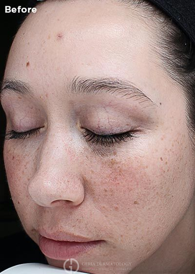 Before Image: Patient Case #6011 - left-front-oblique