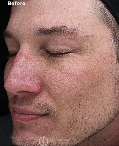 Before Image: Patient Case #6014 - left-front-oblique