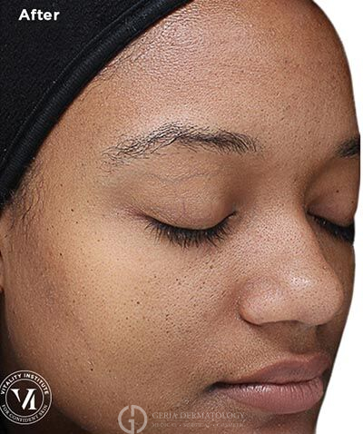 After Image: Patient Case #6017 - right-front-oblique