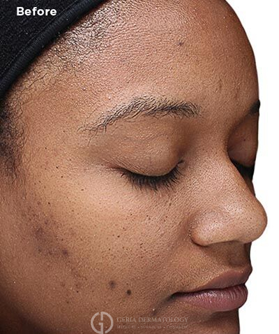 Before Image: Patient Case #6017 - right-front-oblique