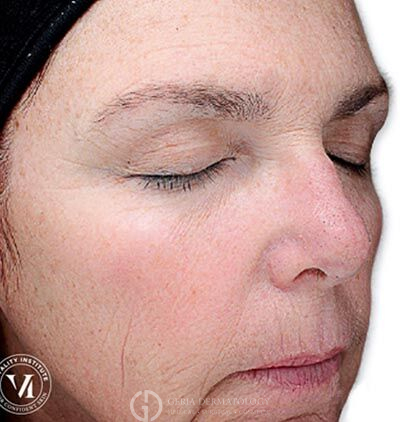 After Image: Patient Case #6020 - right-front-oblique